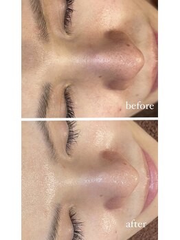 レシェルサロン(Lechelle Salon)/ハーブピーリング