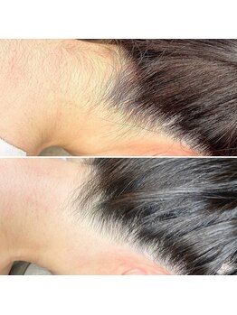 アンドミー(&me)/うなじ.肩.背中上段ワックス脱毛