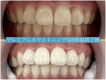 歯のホワイトニング 岐阜アクティブG店