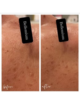 ベレミアム(Bellemium)/目尻のしわケア