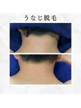 ボゴス(BOGOSS)/うなじ脱毛