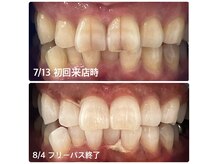 ホワイトニングショップ 福島店(WHITENINGSHOP)の雰囲気（お客様ビフォーアフター♪汚れがしっかり落ちました！）