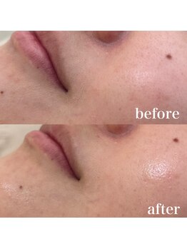 ラクシー 御徒町(luxssy)/顔シェービング