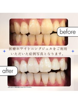 エクシアホワイトニング 麻布十番店/【歯科ホワイトニング】症例