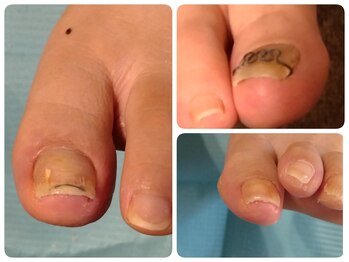 フットケアサロン ラビフット(Rabbi foot)の写真/【巻き爪矯正◇フットケア専門店】最適な施術をご提案し、快適な足元へ導きます！