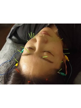 鍼灸施術を受けたい