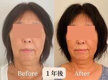 ロシュニ/60代 お悩み:たるみ/右足の痛み