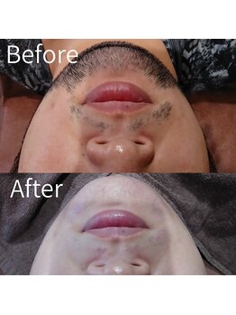 ユウユウ(YUYU)/艶の極み脱毛:ヒゲ