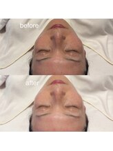 エステサロン ロティオン/落ちないファンデメソスキン