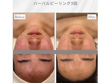 イーズサロン 西大寺店/天然ハーブピーリング肌質改善