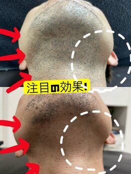 ブラックスワン(Black Swan)/メンズ脱毛★ヒゲ脱毛