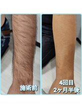 マイセルフ(myself)/腕脱毛例：20代