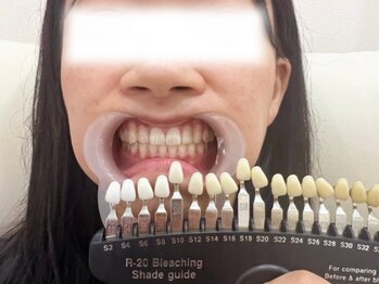 リリス(RiLiS)の写真/【セルフホワイトニング専門店】歯のプロが在籍！白くて清潔感のある歯で第一印象アップ♪