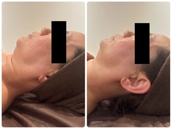 グッドライフエステ/Before＆Afterリフトアップ