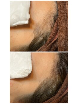 ノノ(nono)/顔脱毛♪