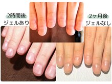 深爪ケアで２時間後には美爪に！さらに２カ月後には縦長お爪☆