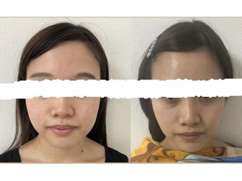 シャインミー(shine me)/顔に触れない小顔矯正ケア