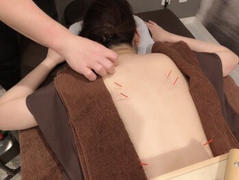 最終形美の写真/1度で感動！本場中国での経験を生かした本格鍼灸施術◆首肩こりを根本改善！全身調整コ-ス60分¥9500→¥4750