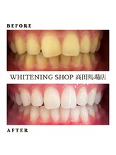 ホワイトニングショップ 高田馬場店/ホワイトニングBeforeAfter