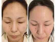 イルソーレ(IL Sole)/継続的ハーブピーリング
