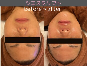 シエスタ(siesta)/シエスタリフト(全顔小顔)