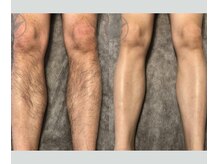 アップパイン(UPPINE)/足脱毛/¥4,400/大国町