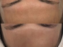 ベアール(beal)/ハーブピーリング5回