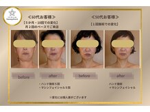 タナゴコロ(tanagokoro)の雰囲気（半顔施術後、鏡を見て変化を確認！比較写真でより小顔を実感）