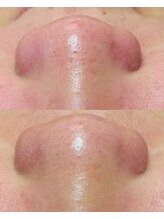 ルーク(Luke)/ニキビケア／くすみ／毛穴