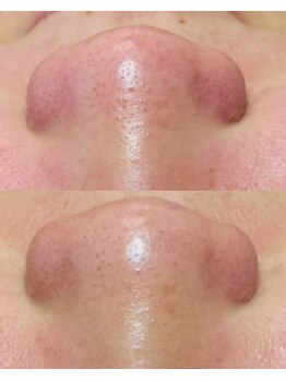 ルーク(Luke)/ニキビケア／くすみ／毛穴