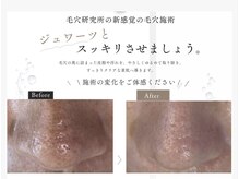 毛穴研究所の雰囲気（ジュワーっと角栓をほぐしながら除去することで毛穴の負担を軽減）