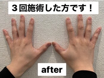 ビューティーデザインアウル(BEAUTY DESIGN OWL)/手指脱毛Before→after