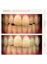 サロンドプラス(Salon de Plus)/【初回】ホワイトニング