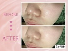 クリアラボ 池袋(Clear Lab)/韓国肌管理&毛穴洗浄専門店