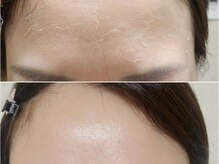 アン(anne)/ハーバルピール☆ レベル1×6回