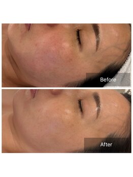 マインエム(mine.m)/敏感肌SEN管理