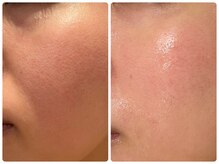 エイシスグロウ(asis glow.)/ララピール×水玉リフティング