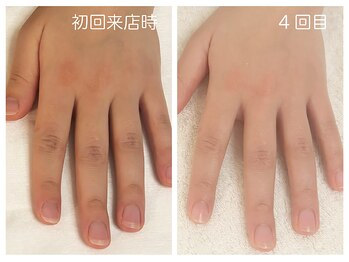 キレイテ 福岡天神店/30代/4回目【天神ハンドケア】