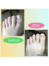 リゼラアンドコー 宇都宮店/巻き爪/肥厚爪、ネイルケア