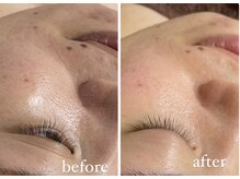 レシェルサロン(Lechelle Salon)/ハーブピーリング