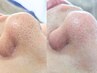 【毛穴の黒ずみ・皮脂詰まりを一斉除去】毛穴洗浄＋毛穴引き締めテラパック