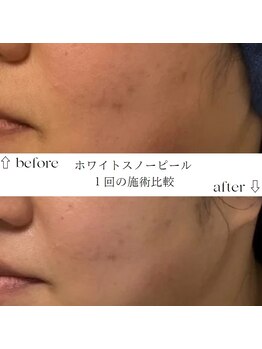 すずき接骨院/ホワイトスノーピール
