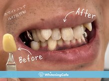 ホワイトニングカフェ 札幌東急百貨店(WhiteningCafe)/◎歯のホワイトニング施術写真◎