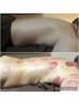 【徹底サイズダウン】脂肪燃焼！燃えろ脂肪★痩身カッピング150分初回19800円