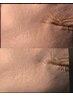 《初回体験》目元のたるみ、シワ集中ケア
