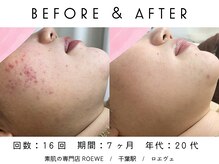 ロエヴェ(ROEWE)/ニキビ改善・毛穴ケア・肌質改善