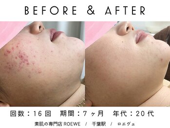 ロエヴェ(ROEWE)/ニキビ改善・毛穴ケア・肌質改善