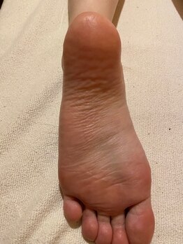 ビサンテ サロン/11)魚の目,たこに角質育成ケア!