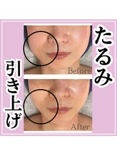 トゥモロー(TOMORROW) 人気No.3小 顔マシーン