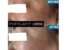 いやされサロン フー(fuu+)/プラズマしみケアでこんなに薄く